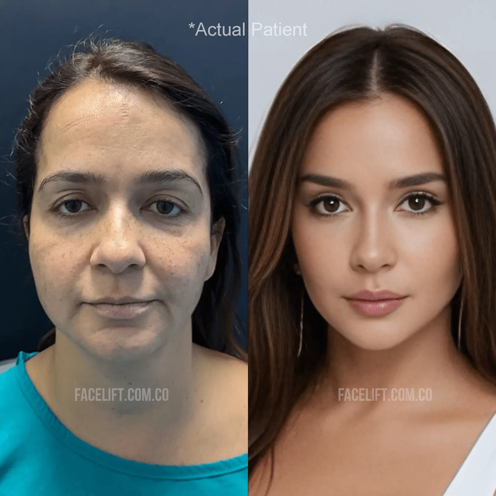 Blefaroplastia antes y después