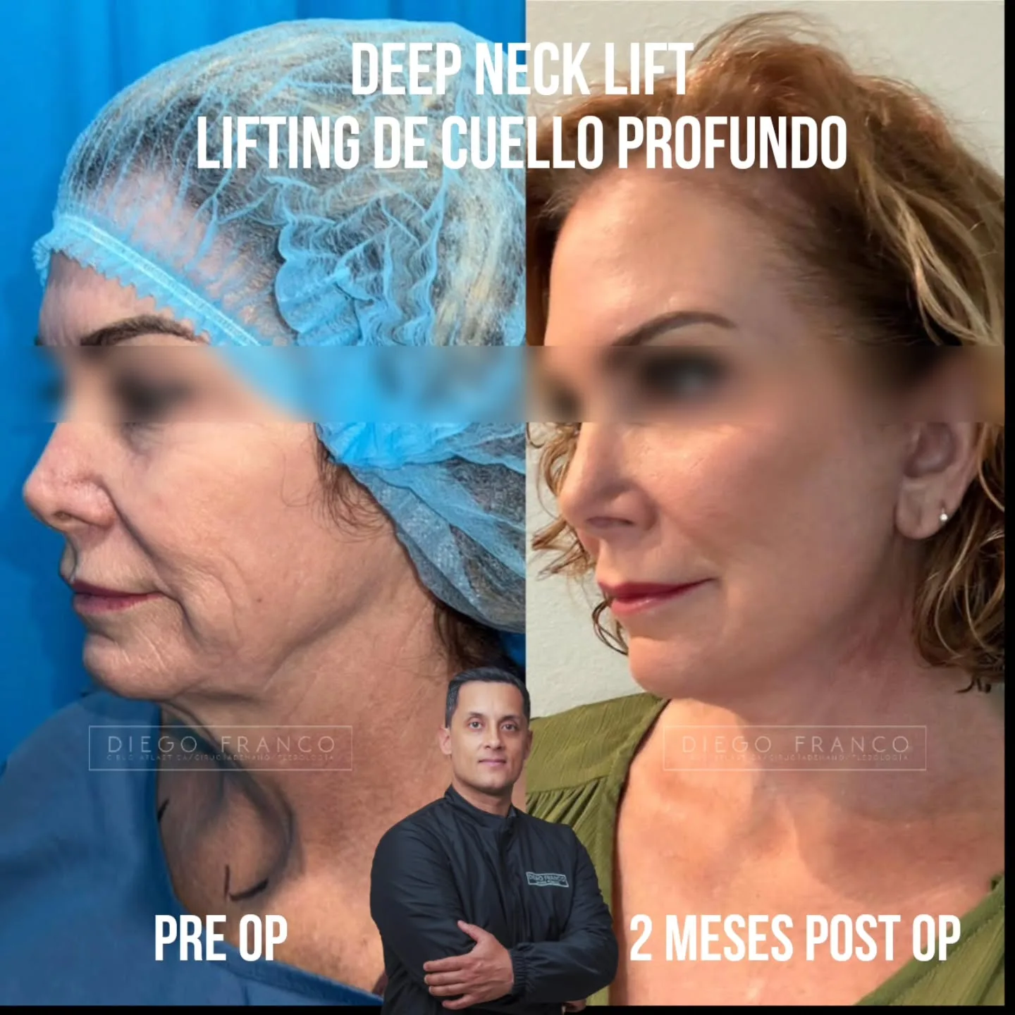 Lifting de cuello antes y después