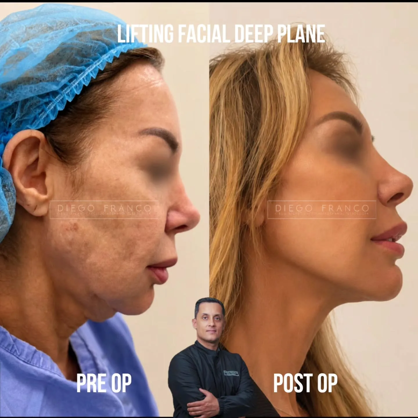 Lifting de plano profundo antes y después
