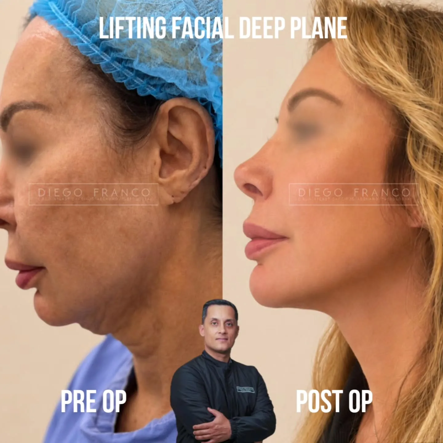 Lifting de plano profundo antes y después
