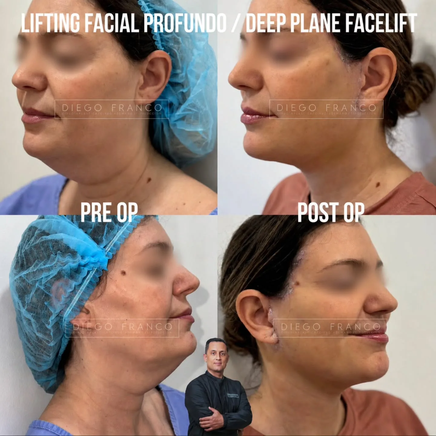 Lifting de plano profundo antes y después