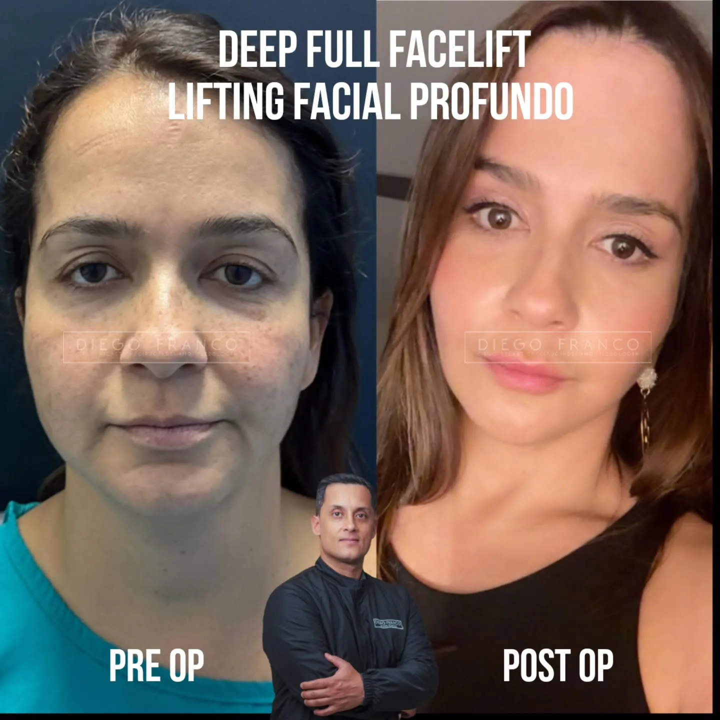Lifting de plano profundo completo antes y después