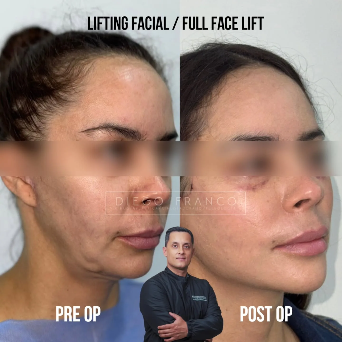 Lifting facial completo antes y después