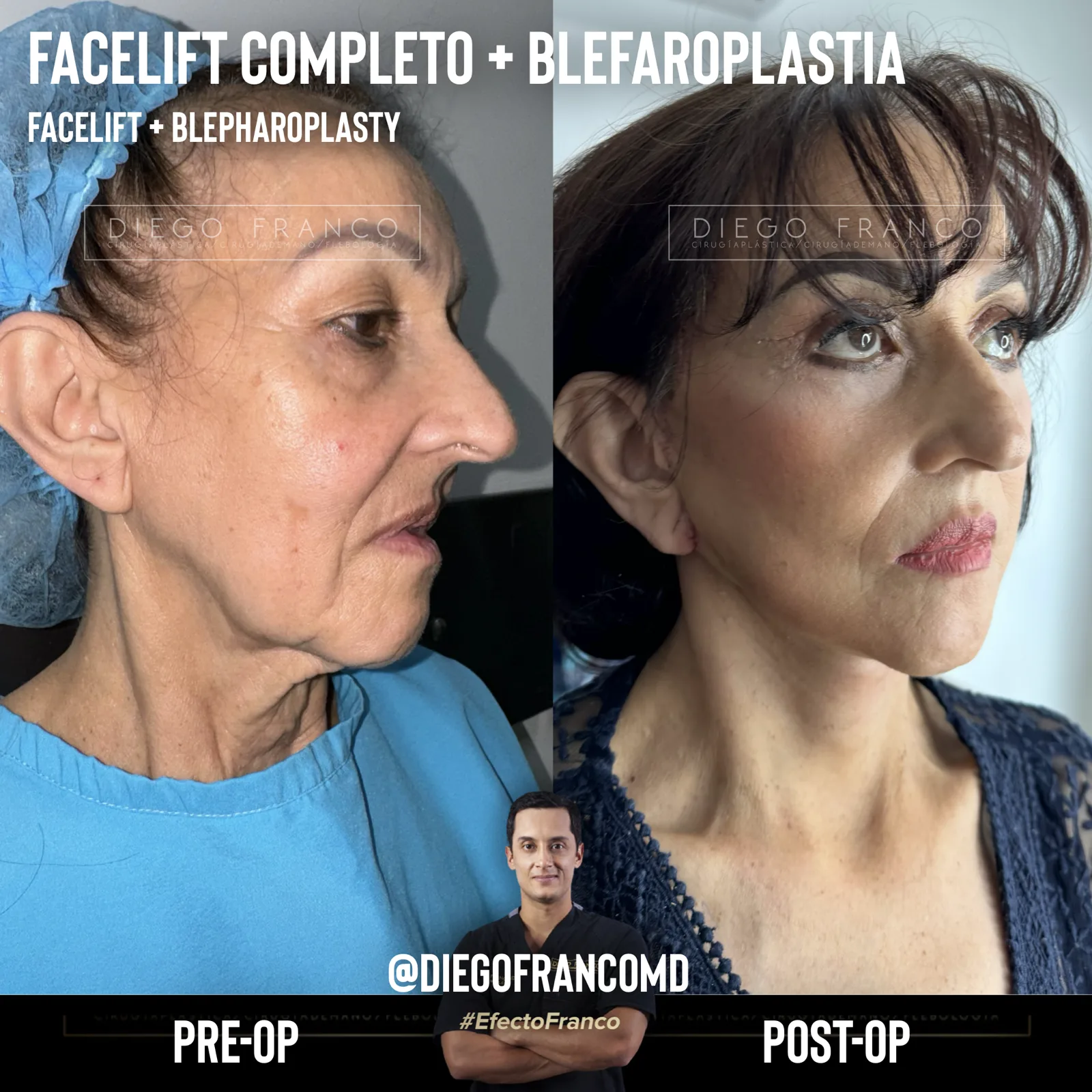 Lifting facial con cirugía de párpados antes y después