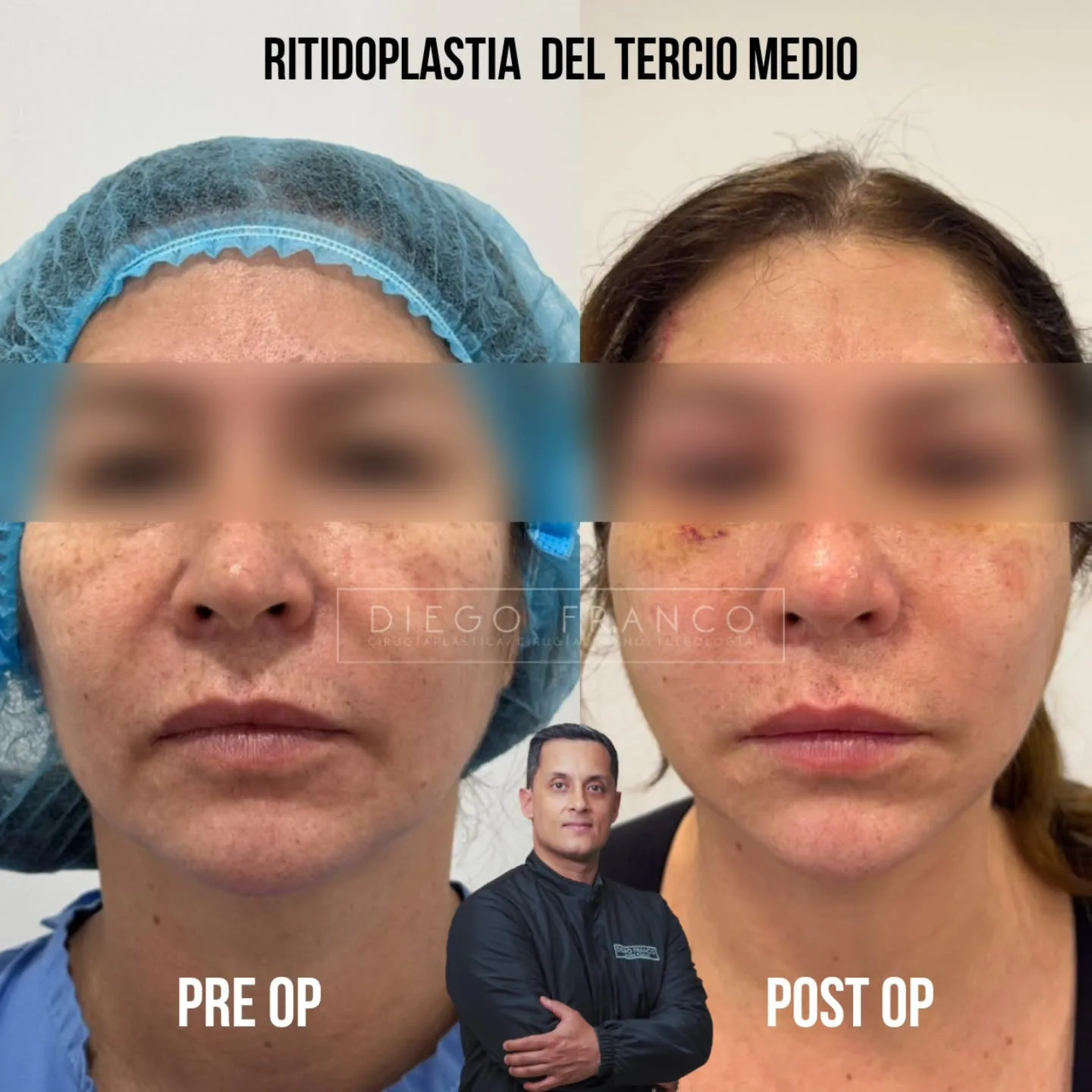Lifting de tercio medio antes y después