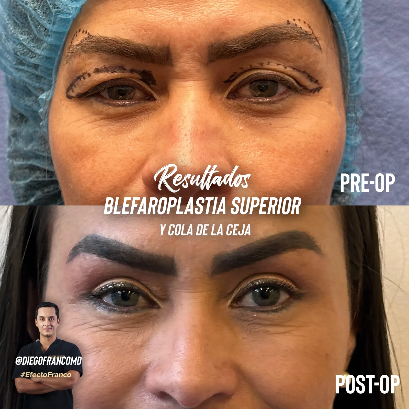 Blefaroplastia superior con lifting de cejas antes y después
